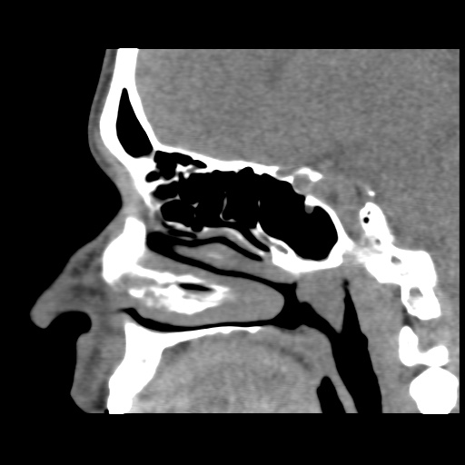 Normal CT paranasal sinuses (Radiopaedia 42286-45390 F 88).jpg