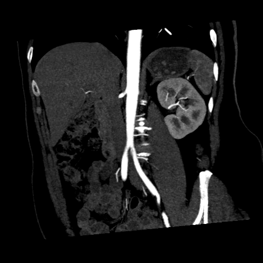 File:Normal CT renal artery angiogram (Radiopaedia 38727-40889 C 12).png
