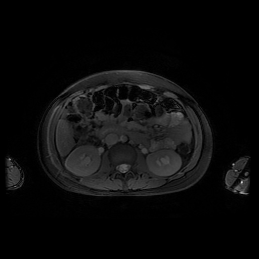 File:Normal MRI abdomen in pregnancy (Radiopaedia 88001-104541 D 24).jpg