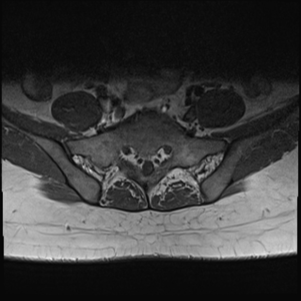 File:Normal lumbar spine MRI- 3 T (Radiopaedia 53280-59250 Axial 32).jpg