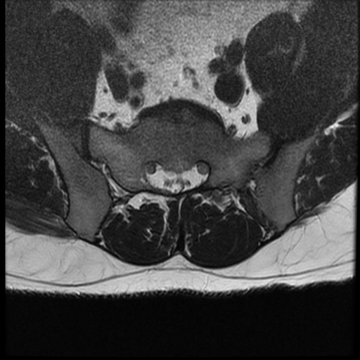 File:Normal lumbar spine MRI (Radiopaedia 35543-37039 Axial T2 4).png