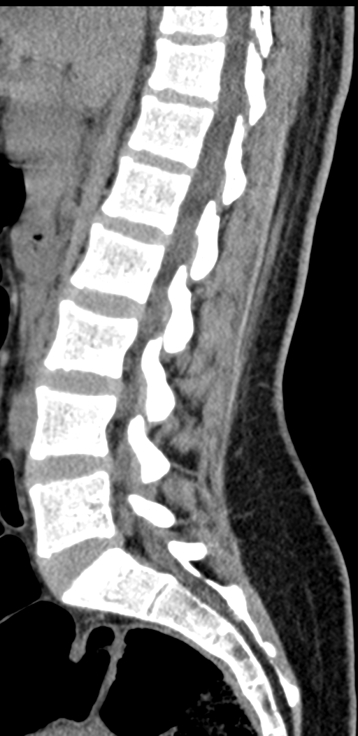 Normal lumbosacral CT (Radiopaedia 37923-39867 E 61).png