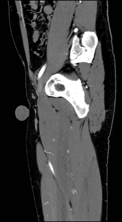 Normal pelvis CT angiogram (Radiopaedia 84966-100481 C 73).jpg
