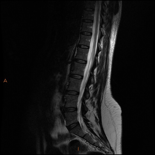 File:Normal spine MRI (Radiopaedia 77323-89408 Sagittal T2 6).jpg