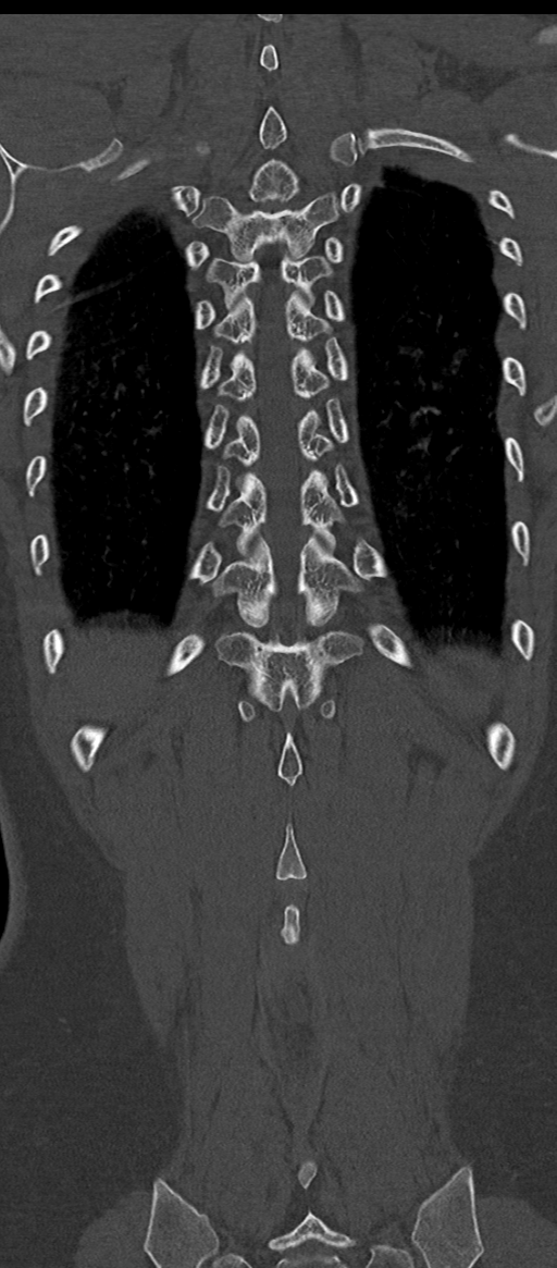 Normal thoracolumbar spine (Radiopaedia 43822-47309 Coronal bone window 74).png