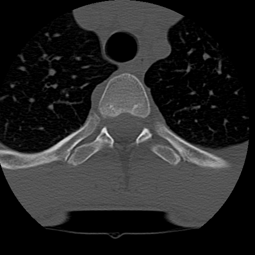 Normal trauma spine imaging (age 16) (Radiopaedia 45335-49358 Axial bone window 95).jpg