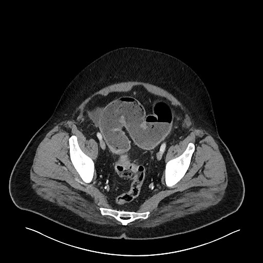 Obstructing sigmoid adenocarcinoma (Radiopaedia 58465-65619 A 139).jpg
