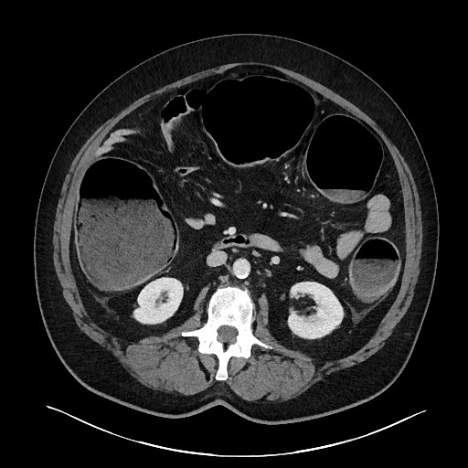 Obstructing sigmoid adenocarcinoma (Radiopaedia 58465-65619 A 75).jpg