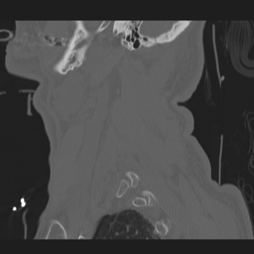 File:Occipital condyle fracture (Radiopaedia 33467-34517 Sagittal bone window 65).png