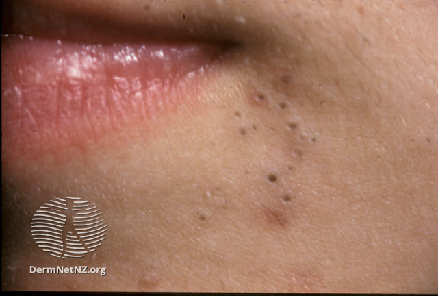 File:Open comedones (DermNet NZ acne-comedones-57-v2).jpg