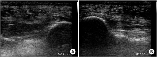 a)Ultrasonographic finding of plantar fasciitis b)normal sonographic finding