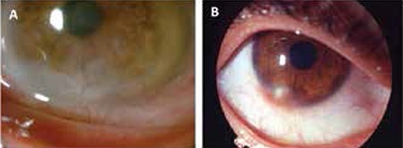 Clinical features/complications- Anterior segment photographs showing corneal neovascularization (A) and peripheral corneal infiltrate (B)