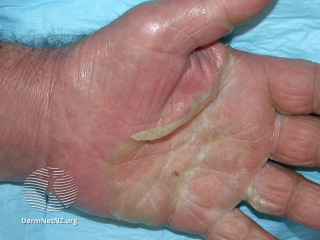 File:Peeling palmar skin (DermNet NZ reactions-agep6).jpg