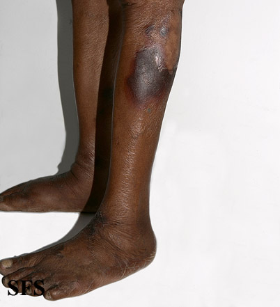 File:Pellagra (Dermatology Atlas 53).jpg