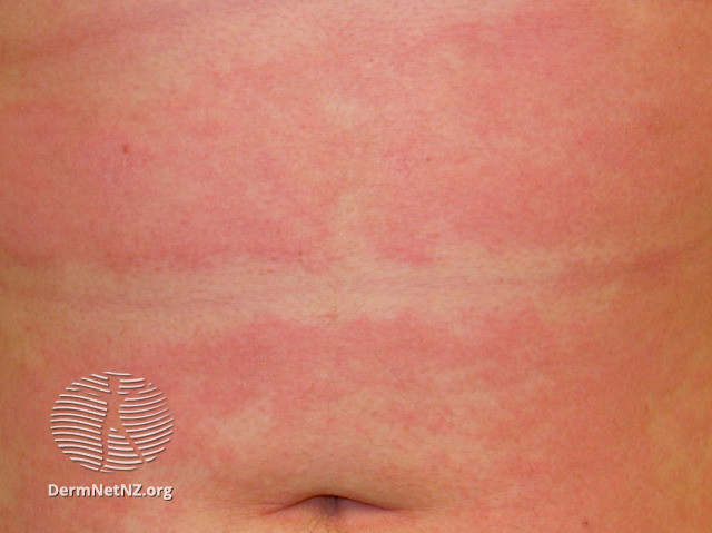 File:Subacute atopic dermatitis (DermNet NZ SCORAD-atopic-excoriation-0).jpg