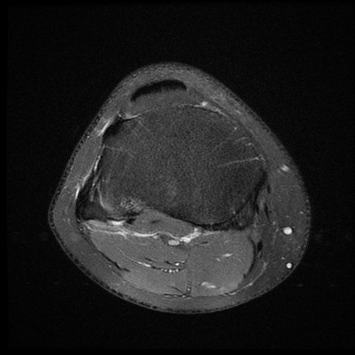 File:ACL acute full thickness tear - deep lateral femoral sulcus sign (Radiopaedia 38594-40740 Axial PD fat sat 20).jpg