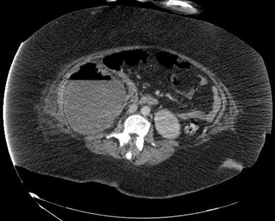 File:Abdominal abscess - pre and post percutaneous drainage (Radiopaedia 60209-67816 Axial 5).png