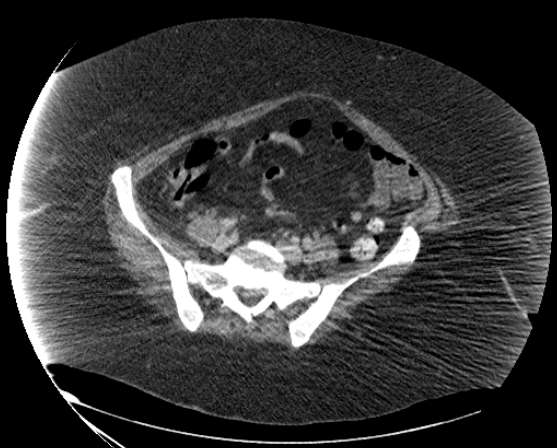 File:Abdominal abscess - pre and post percutaneous drainage (Radiopaedia 60209-67816 Axial 74).png