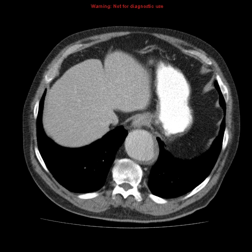 File:Abdominal aortic aneurysm (Radiopaedia 10122-10660 Axial C+ portal venous phase 11).jpg