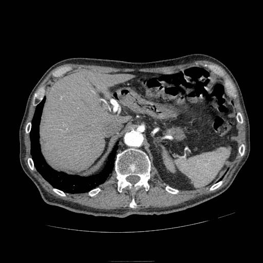 Abdominal aortic aneurysm (Radiopaedia 13341-13340 Axial C+ arterial phase 38).jpg