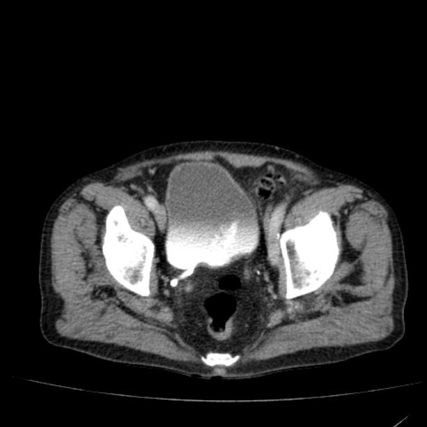 Abdominal aortic aneurysm (Radiopaedia 29248-29660 Axial C+ portal venous phase 55).jpg