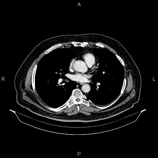 File:Abdominal aortic aneurysm (Radiopaedia 83094-97462 Axial renal cortical phase 42).jpg