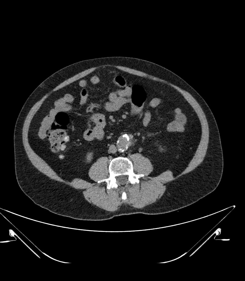 Abdominal aortic aneurysm with thrombus fissuration (Radiopaedia 46218-50618 Axial non-contrast 30).jpg