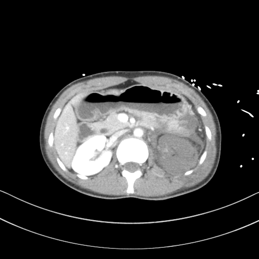 File:Abdominal multi-trauma - devascularised kidney and liver, spleen and pancreatic lacerations (Radiopaedia 34984-36486 Axial C+ portal venous phase 30).png