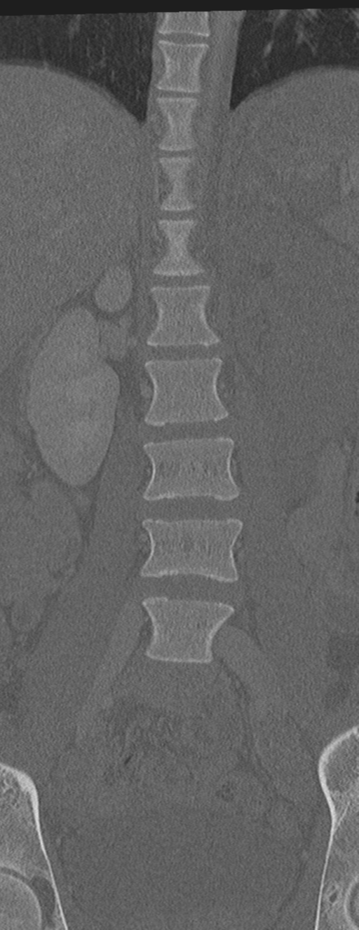 Abdominal multi-trauma - devascularised kidney and liver, spleen and pancreatic lacerations (Radiopaedia 34984-36486 Coronal bone window 21).png
