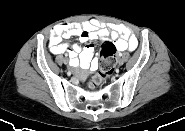 Abdominal wall and retroperitoneal tuberculosis (Radiopaedia 88137-104729 Axial C+ portal venous phase 148).jpg