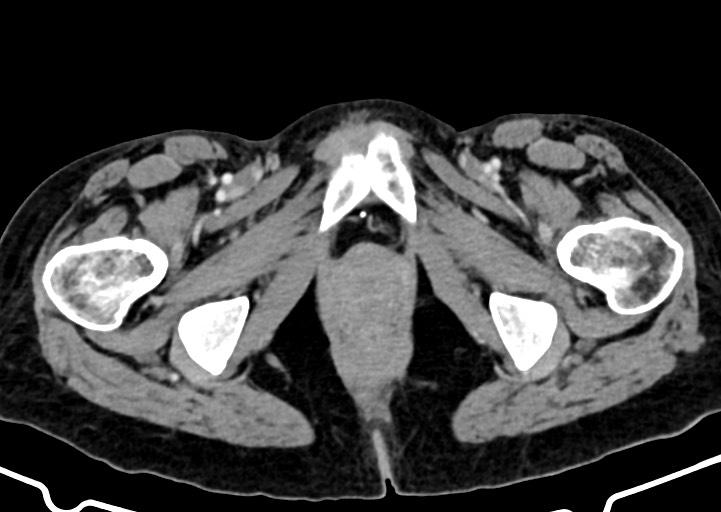Abdominal wall and retroperitoneal tuberculosis (Radiopaedia 88137-104729 Axial C+ portal venous phase 197).jpg