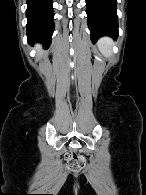 Abdominal wall and retroperitoneal tuberculosis (Radiopaedia 88137-104729 Coronal C+ portal venous phase 90).jpg