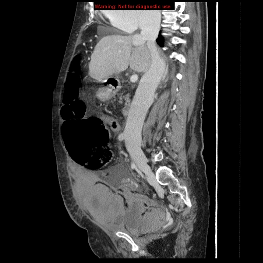 Abdominal wall hematoma (Radiopaedia 9427-10112 Sagittal C+ portal venous phase 61).jpg