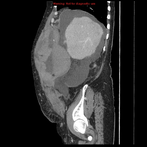 Abdominal wall hematoma (Radiopaedia 9427-10112 Sagittal C+ portal venous phase 83).jpg
