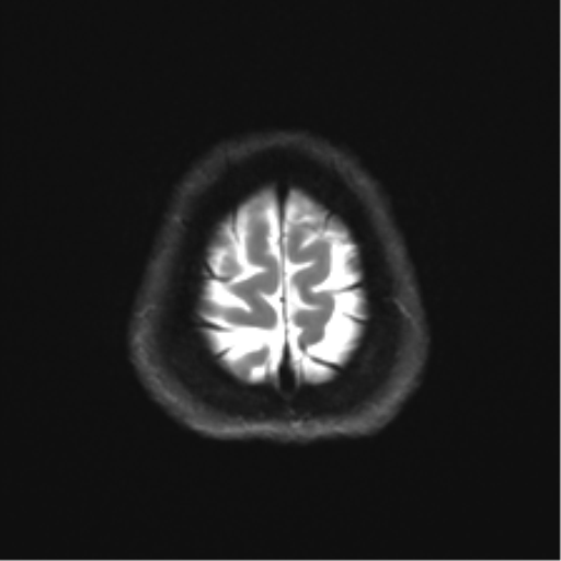 Abducens nerve palsy (Radiopaedia 51069-56648 Axial DWI 25).png