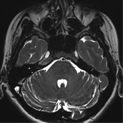 Abducens nerve palsy (Radiopaedia 51069-56648 Axial T2 fat sat 30).png