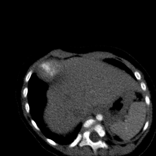 File:Aberrant left pulmonary artery (pulmonary sling) (Radiopaedia 42323-45435 Axial C+ CTPA 40).jpg