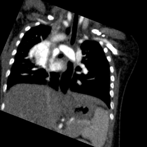File:Aberrant left pulmonary artery (pulmonary sling) (Radiopaedia 42323-45435 Coronal C+ CTPA 12).jpg