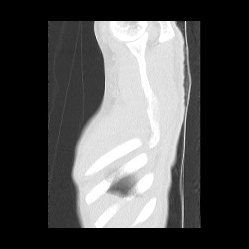 Accessory left horizontal fissure with lingular pneumonia (Radiopaedia 53763-59843 Sagittal lung window 64).jpg