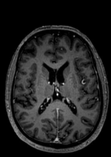 Accessory middle cerebral artery (Radiopaedia 73114-83828 Axial T1 C+ 7).jpg