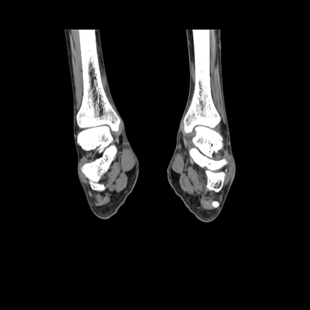 Accessory soleus muscle (Radiopaedia 61069-68943 Coronal non-contrast 41).jpg