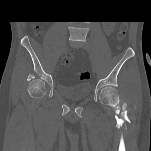 Acetabular and ilial fractures (Radiopaedia 59084-66378 Coronal bone window 23).jpg