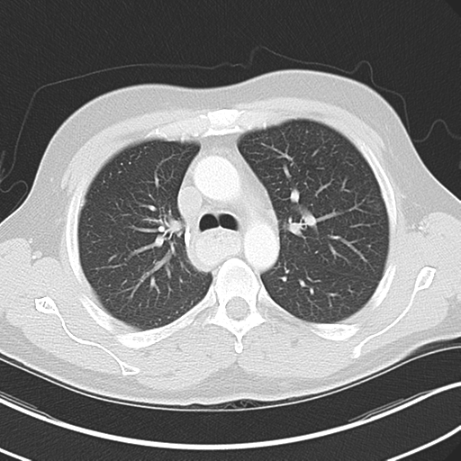 Achalasia of the cardia (Radiopaedia 38497-40595 Axial lung window 19).png