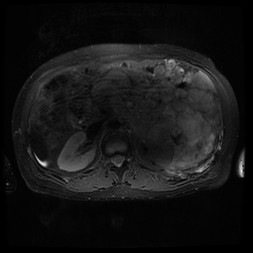 Acinar cell carcinoma of the pancreas (Radiopaedia 75442-86668 Axial T2 fat sat 36).jpg
