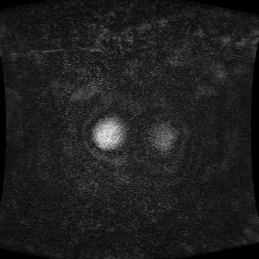 Acinar cell carcinoma of the pancreas (Radiopaedia 75442-86668 Coronal T1 C+ fat sat 194).jpg
