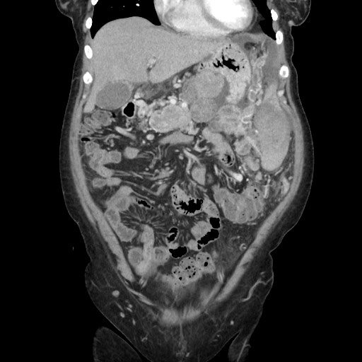 File:Acinar cell carcinoma of the pancreas (Radiopaedia 75442-86669 Coronal C+ portal venous phase 38).jpg