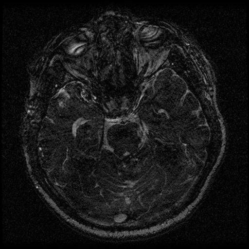 Acoustic schwannoma (Radiopaedia 33045-34060 Axial T2 69).png