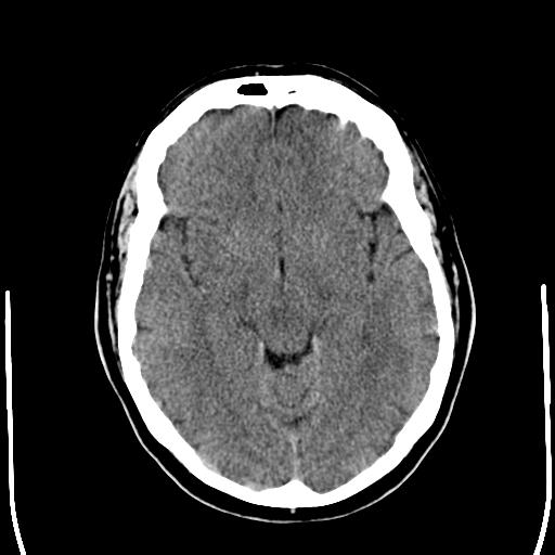 File:Acoustic schwannoma - cystic (Radiopaedia 29487-29980 AXIAL THICK non-contrast 12).jpg