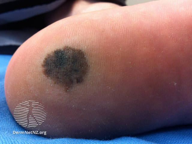 File:Acral lentiginous melanoma (DermNet NZ acral-lentiginous-melanoma-3).jpg