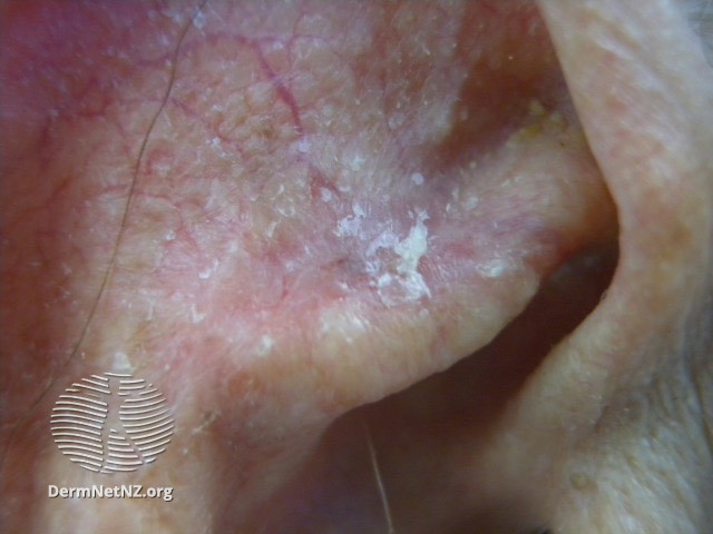 Actinic Keratoses affecting the face (DermNet NZ lesions-ak-face-303).jpg